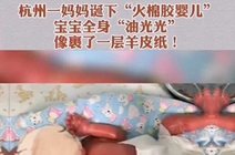 一夕夙愿2020-09-07杭州一妈妈诞下"火棉胶婴儿,宝宝全身"油光光,像