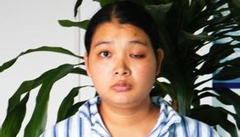 痛性眼肌麻痹