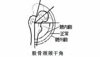 颈干角