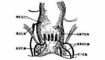 肛门瘘管