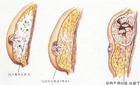 乳腺癌根治术