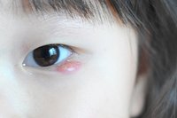 吸收,也可缓慢增大,可按摩或热敷,促进吸收消散;大的散粒肿需手术摘除