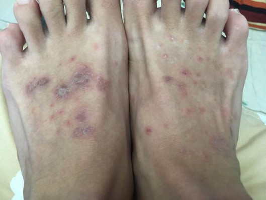 湿疹性皮炎怎么治疗?总有一种方法适合你_【今日爆点】