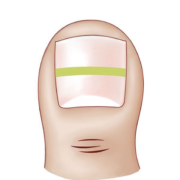 甲沟炎手术多久能吃辣 为什么甲沟炎手术后