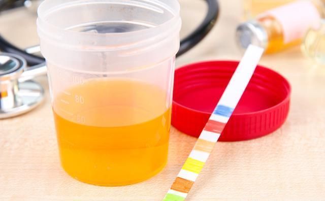 尿液中酮体高是怎么回事呢?