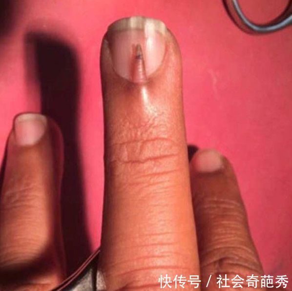 男子指甲盖上长出小指甲,去医院检查,引发国际医学界关注