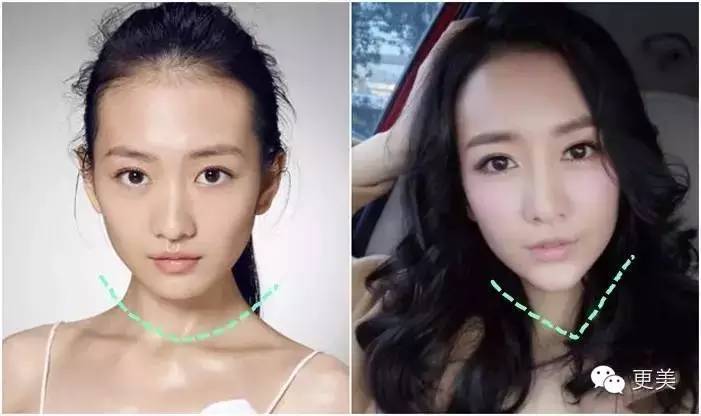 加长了下巴,脸型变瓜子脸,整个人是不是成熟了很多?