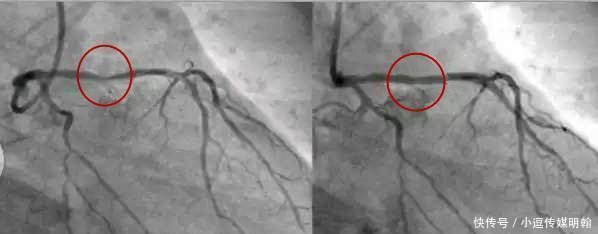 这就是心脏支架, 曾帮助了多少病人