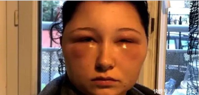 19岁的美女染染发剂几乎致命的过敏反应,导致