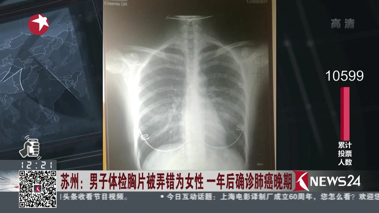 咳嗽四天了需要拍胸片吗