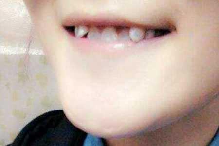 虎牙到底能不能拔?看看王俊凯是怎么做的…