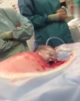 医生为孕妇剖腹后让婴儿自己爬出母体 - 谭笑古今 - 谭笑古今 医生为孕妇剖腹后让婴儿自己爬出母体 - 谭笑古今 - 谭笑古今
