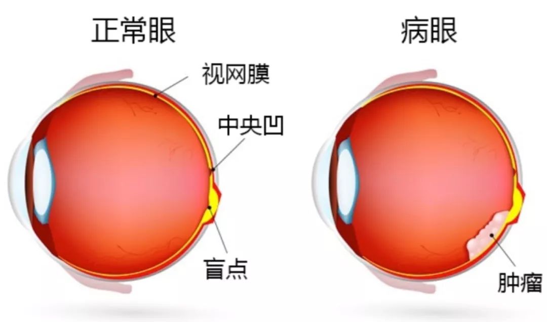 出国看病:质子治疗视网膜母细胞瘤副作用