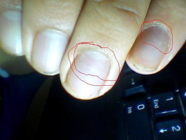 指甲盖从内向外蔓延凹凸不平的指甲一开始一个