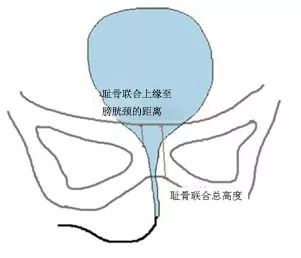 前列腺癌患者的福音:保留Retzius间隙机器人辅助根治性前列腺切除