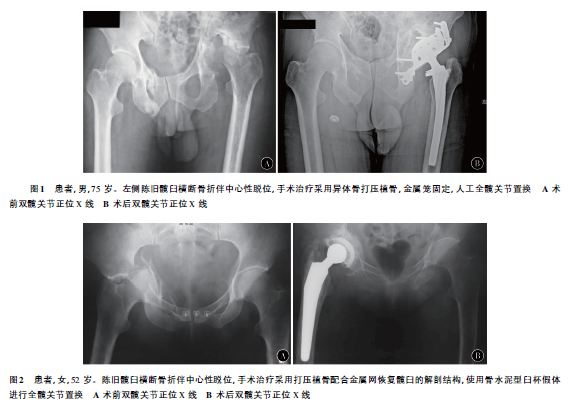 髋臼骨折晚期人工全髋关节置换的难点