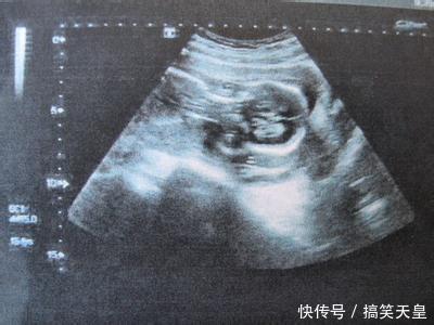 孕妇到医院产检, B超显示的画面医生看后都直