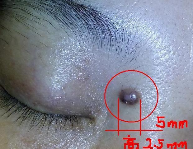 5mm. 我想问: 1,这个属于什么类型的痣?危险不? 2,这个用什么手术做?