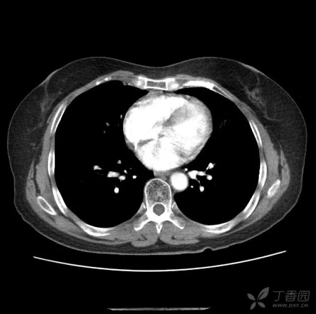 分叶+毛刺+GGO=肺腺癌?NO!