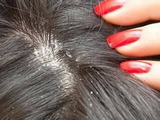 老中医的中药去屑洗发水,加点荔枝壳,止痒效果更棒