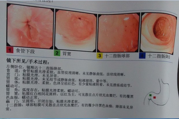 电子胃镜诊断为慢性非萎缩性胃炎糜烂性十二指肠球炎并有幽门螺旋杆菌