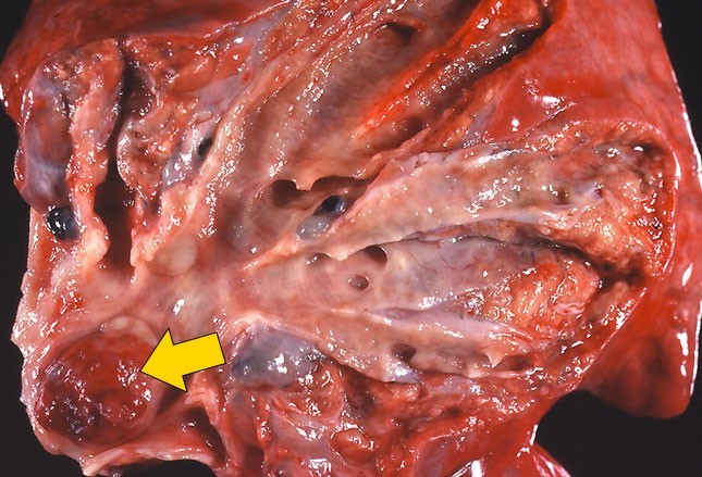 可以看出一个很大的息肉样肿瘤完全阻塞住了肺叶支气管管腔.