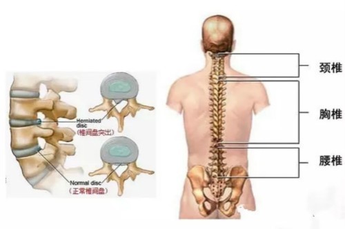 腰间盘突出可以治好吗