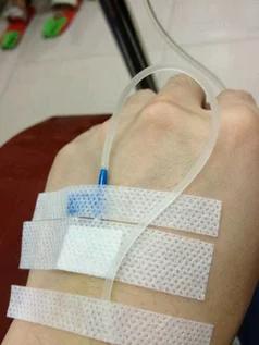 孩子输液时,你还纠结用钢针还是留置针吗?