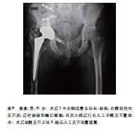 髋臼骨折晚期人工全髋关节置换的难点