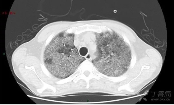 双肺弥漫性铺路石征，你考虑什么?