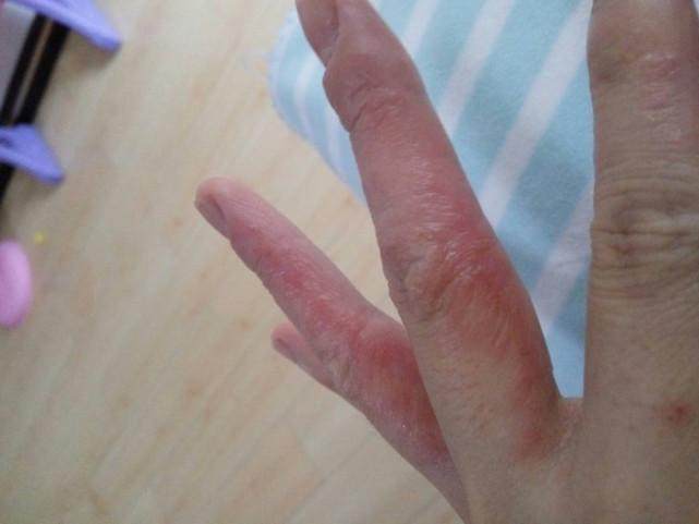 手上起小水泡痒怎么办? 很不幸, 是身体出问题