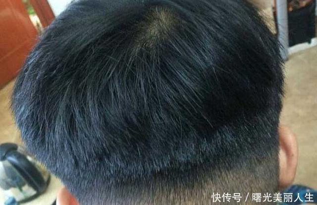 头发种植一般多少钱 头发种植的注意事项