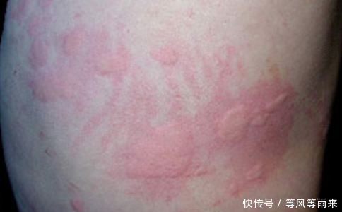 丘疹性荨麻疹的诊断及饮食禁忌