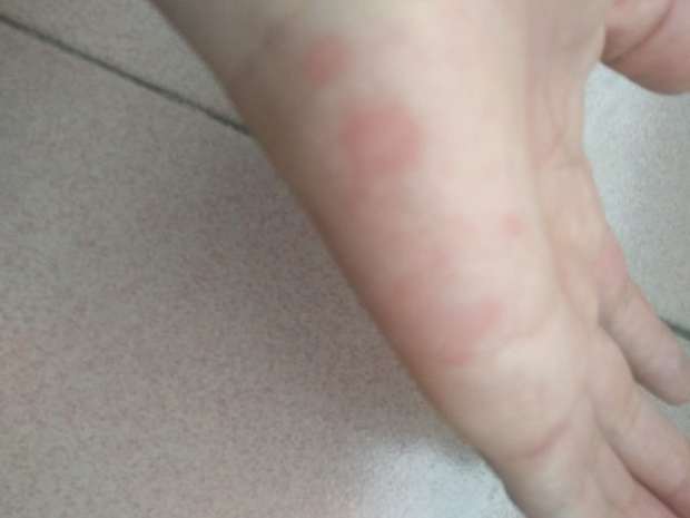 最多就是吃了些去风湿的药       可能是皮肤过敏 尽量少去户外 尽量