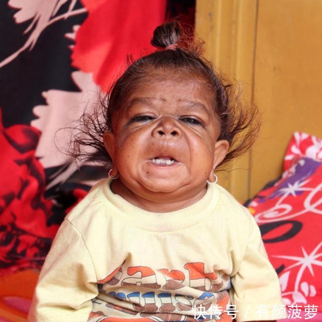 21岁印度男子看起来像6个月大的婴儿,父母盼他