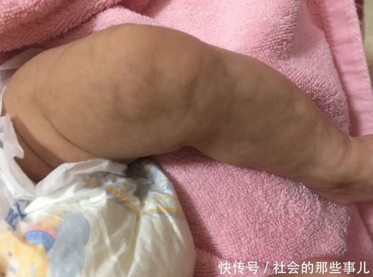 儿子4个月大，腿突然变成蛇皮，爸妈紧急送医，医生:庆幸来得早