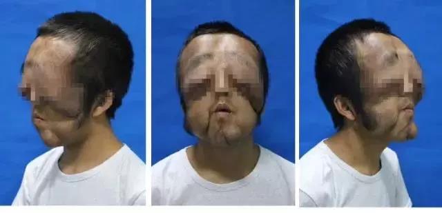 18岁\"狮面人\"今日康复出院 一附院多学科联合诊治再创奇迹