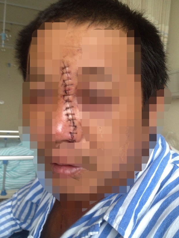 (是浙江金华地区,农村户口)如果是起诉的话大概可以判定为几级伤残