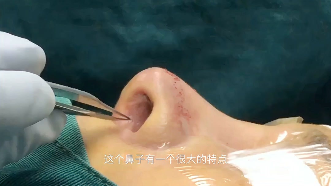 隆鼻手术