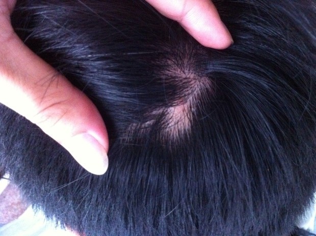 我想知道<em>脱头发</em>到底<em>是什么</em>原因?该怎么办?。