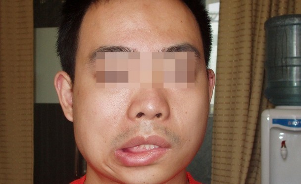 一般症状是口眼歪斜它是一种常见病