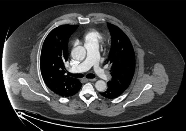 一觉醒来出现偏瘫,患者到底怎么了?