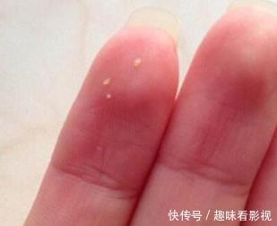 怎么去掉脸上的螨虫?一把草把螨虫一点点扼杀