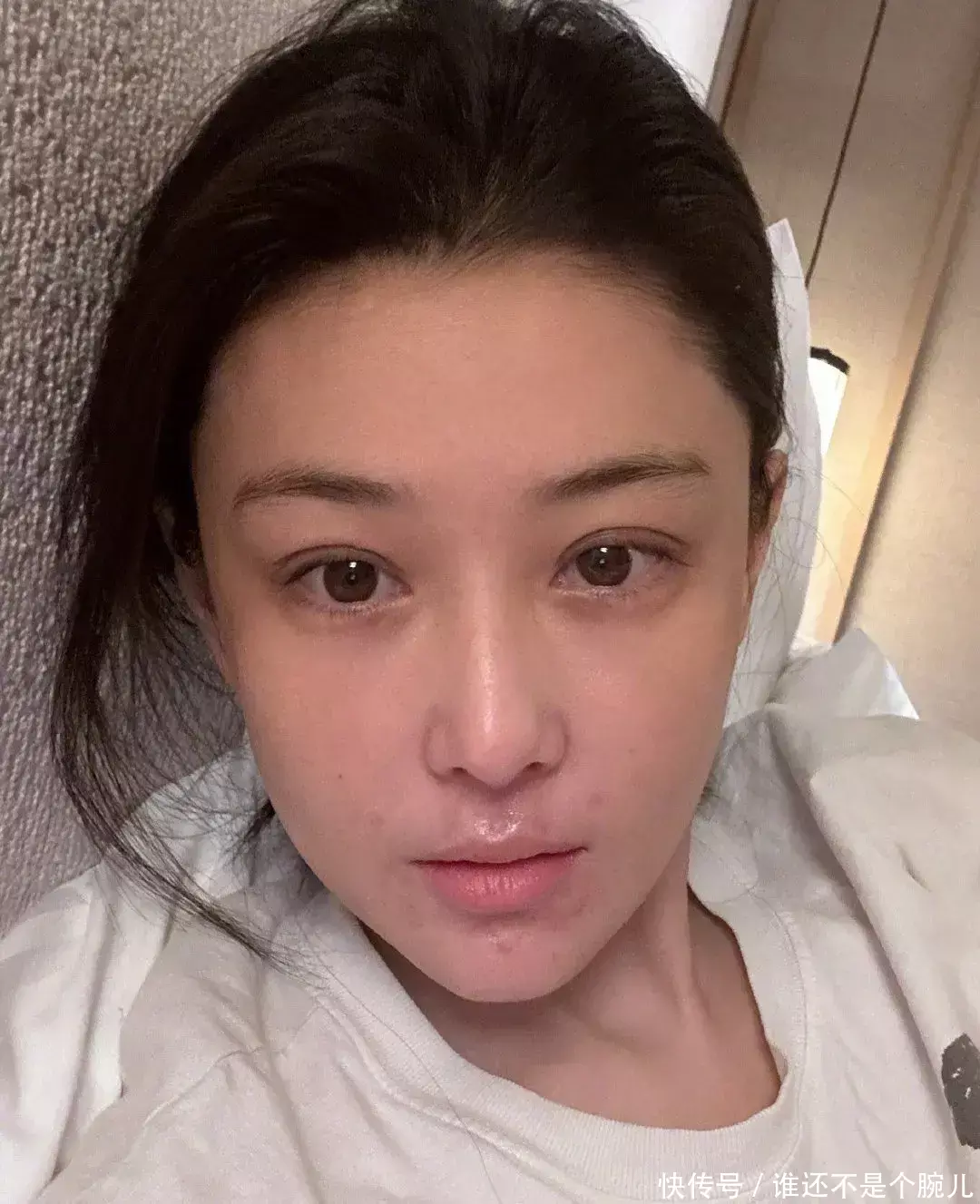 张馨予 张馨予分享素颜近照，皮炎复发面部出现疤痕，透露爆发期很吓人！ - 360娱乐