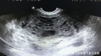 怀孕5个月时出现腹痛和出血,检查却没发现胎儿
