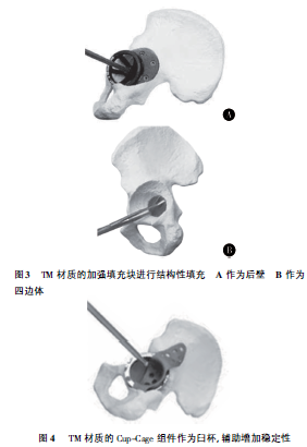 髋臼骨折晚期人工全髋关节置换的难点