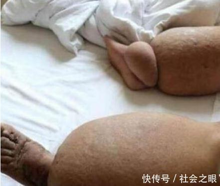 男子双腿200斤，四处求医，医生束手无策，跳广场舞突然见奇效