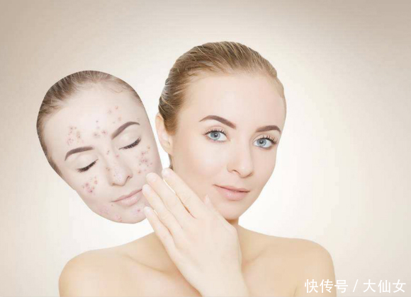 激素依赖性皮炎导致脸上长疹子是怎么办 疹子