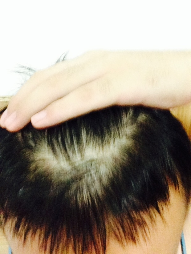 才18啊。<em>头发掉的好多</em>,头顶都要秃了怎么办啊