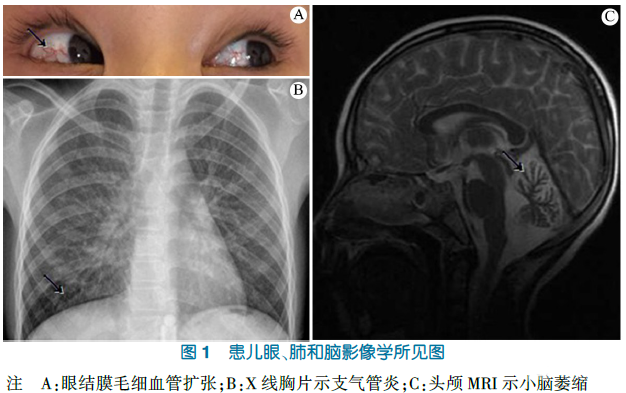 共济失调毛细血管扩张症1例病例